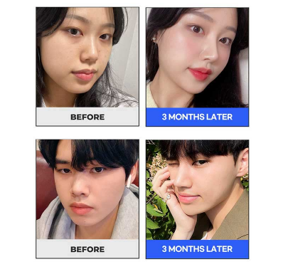 앤플러스의원 자가늑코성형 이벤트😍 관련 이미지 6