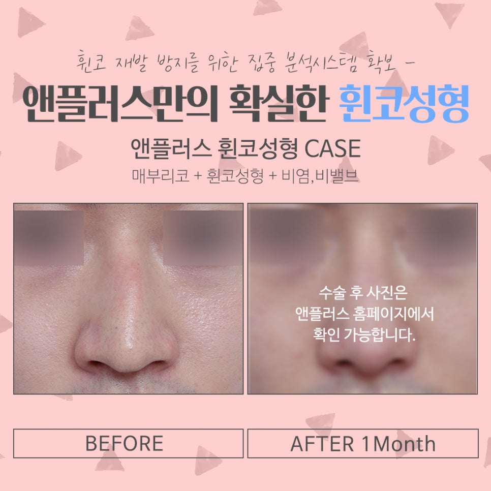 휜코수술후기 꼼꼼하게 알아보고 관련 이미지 14