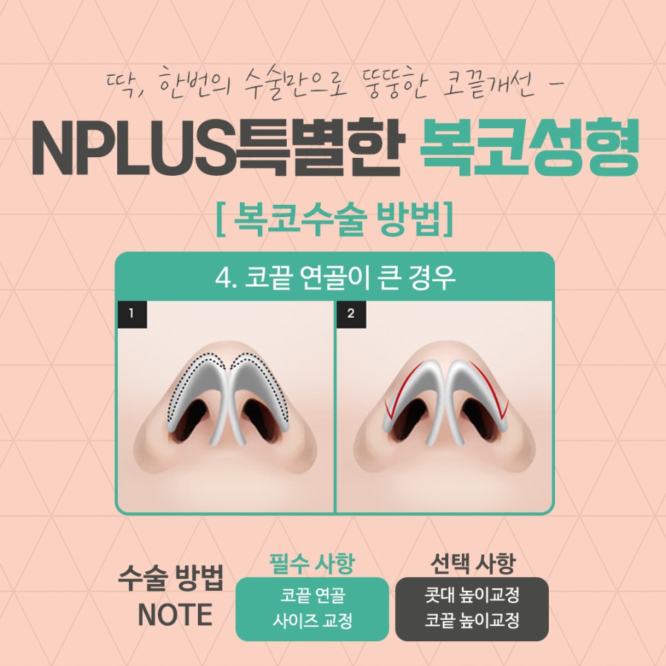 복코성형후기 코지방제거로 확실하게 관련 이미지 10