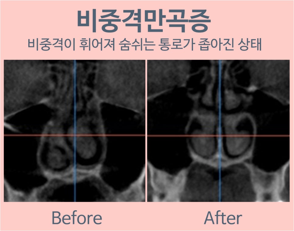 Septoplasty Surgery at N+ image 4