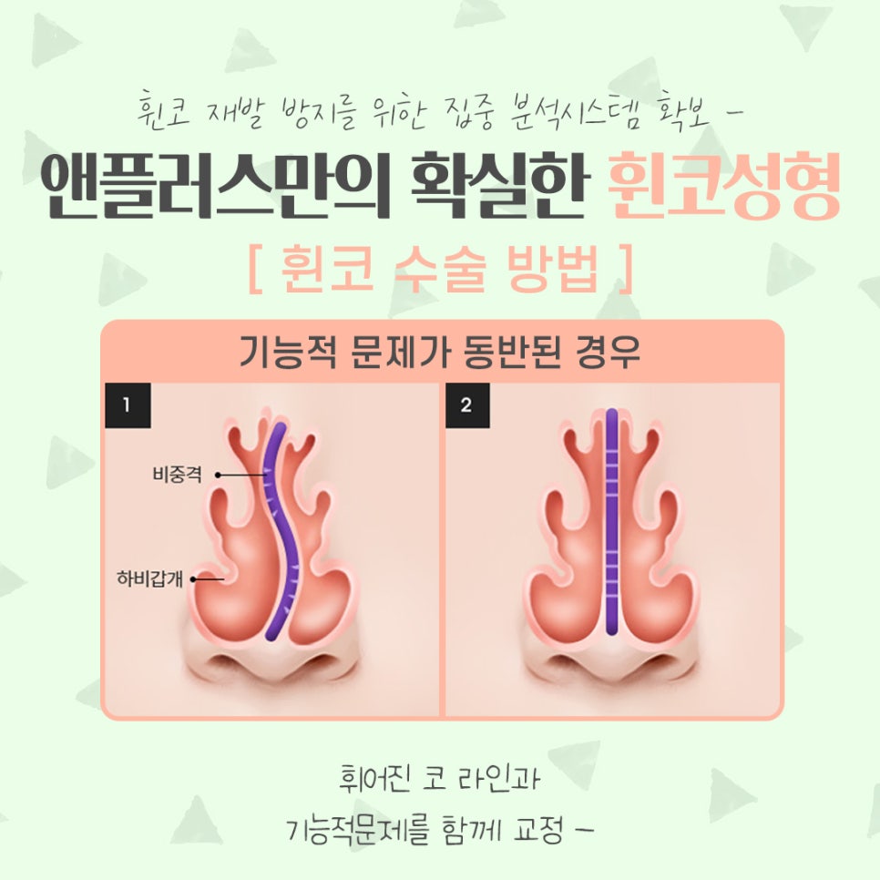휜코성형후기 자세하게 알아보고 관련 이미지 11