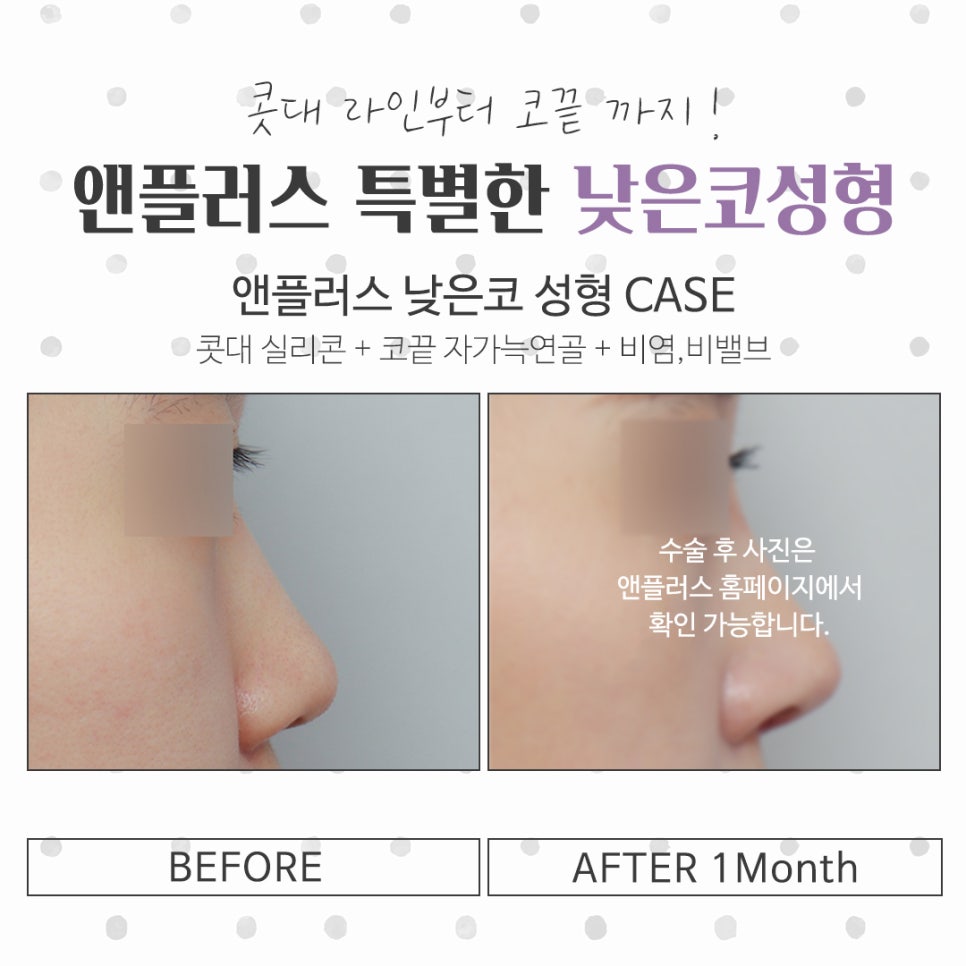 Checking Low Nose Surgery Reviews Too image 14
