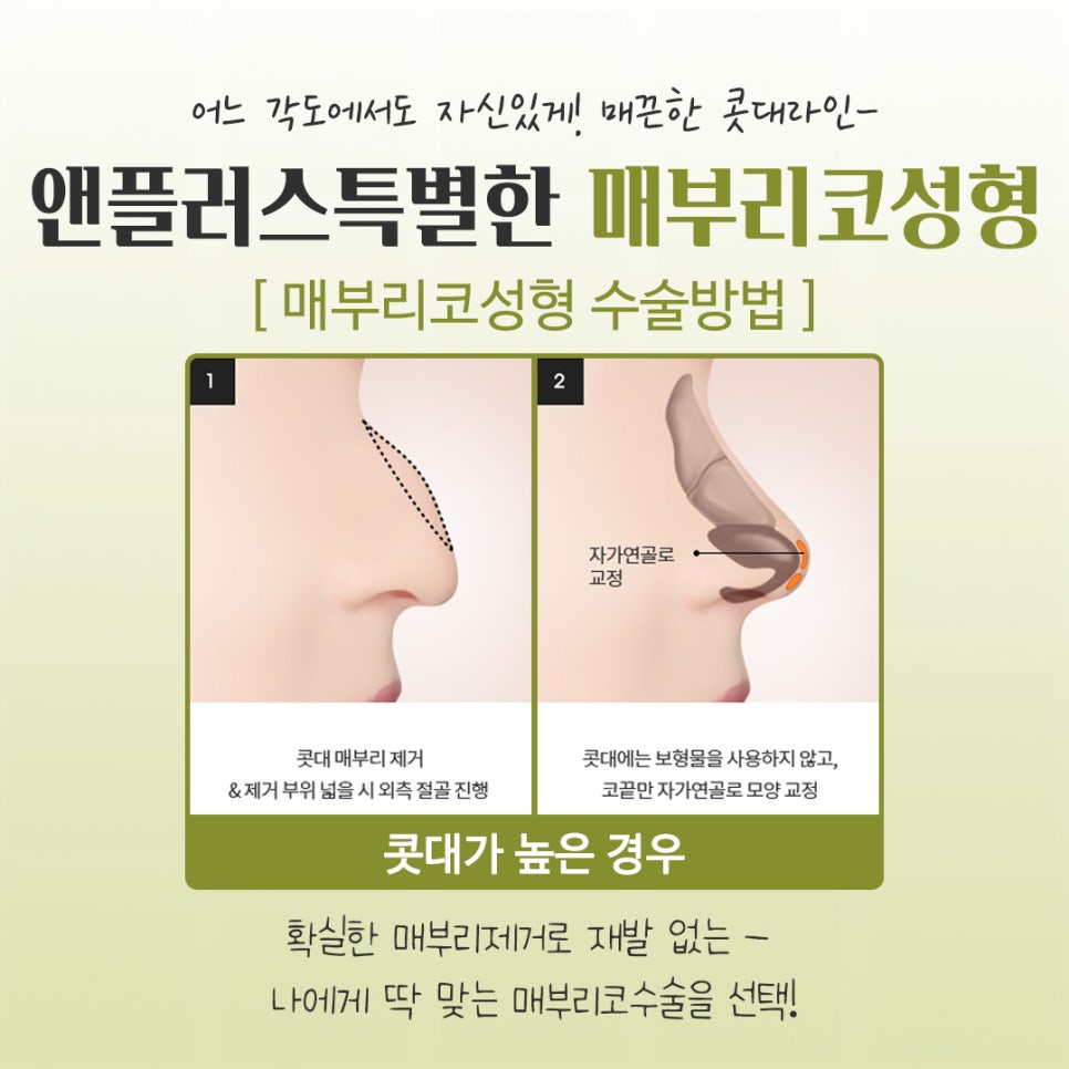 매부리코수술후기 다양한 이미지를 확인하고 관련 이미지 8