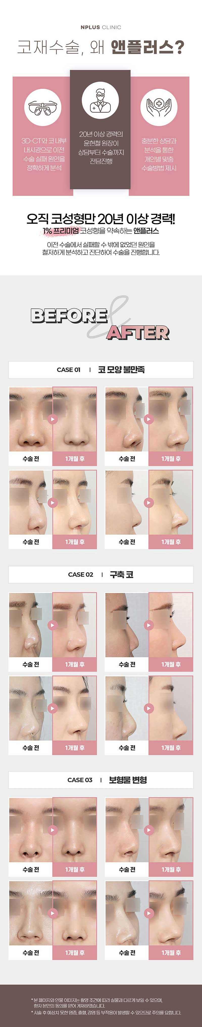 앤플러스의원 코재수술이벤트로 자연스럽고 예쁘게- 관련 이미지 3