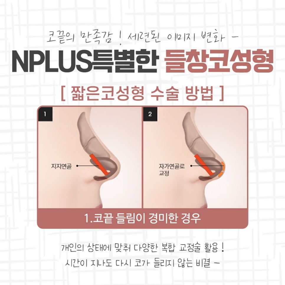 들창코성형 선택의 중요성 관련 이미지 8