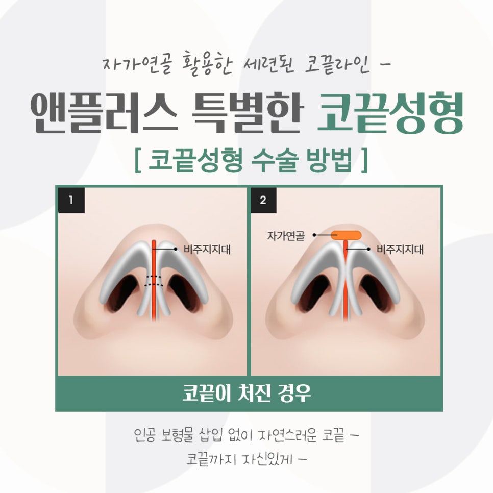 코끝연골묶기로 자연스러운 코라인 관련 이미지 9