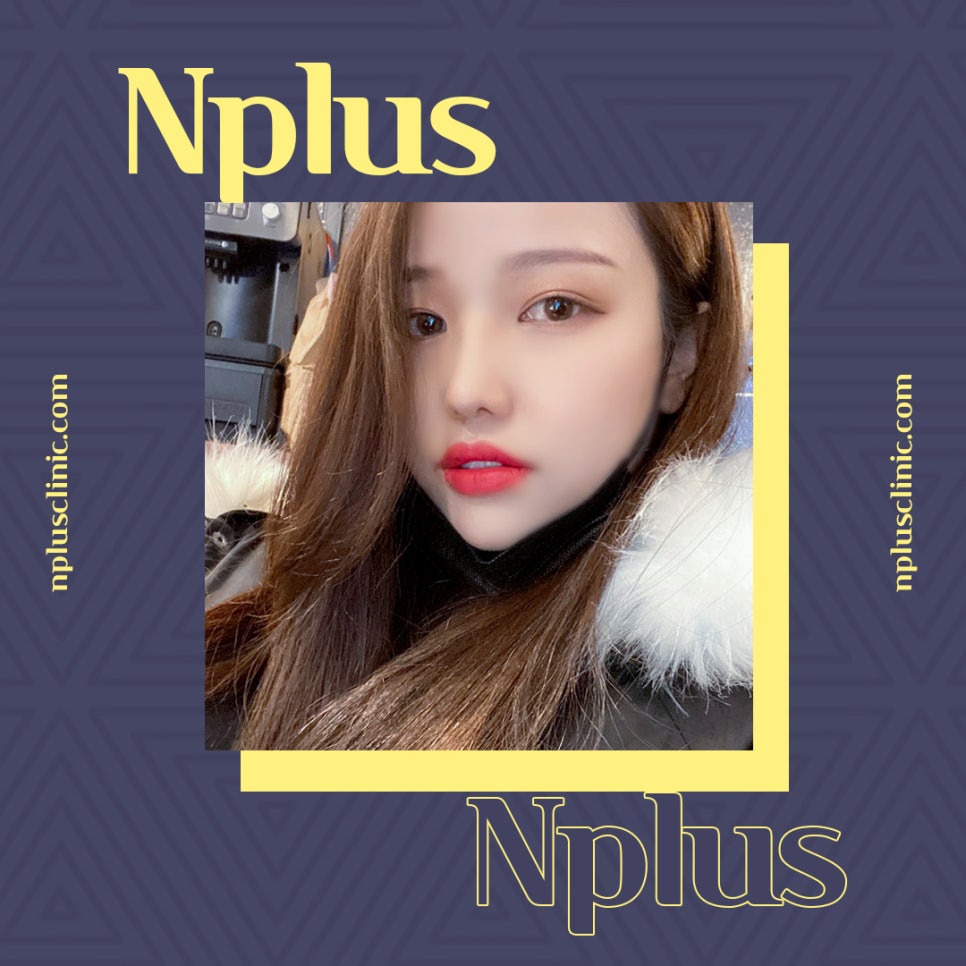 Non-Scar Alar Reduction to Improve a Bulbous Nose image 1
