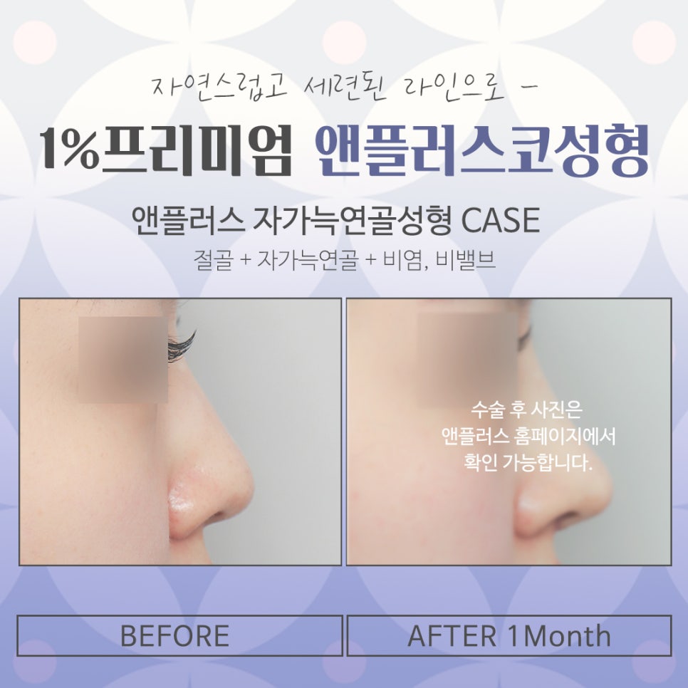 자가늑코수술 내게 어울리는 라인으로 관련 이미지 15