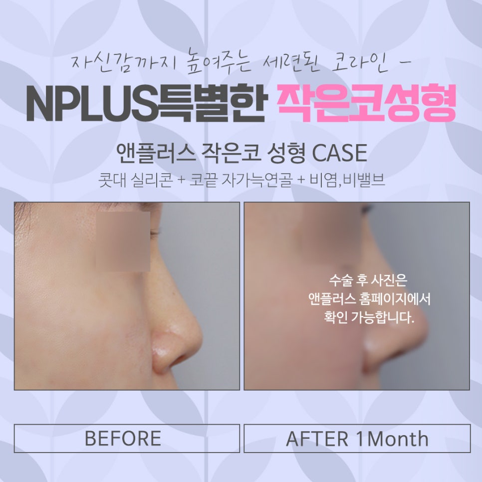 Review of Small Nose Rhinoplasty: Learn About It Carefully image 13