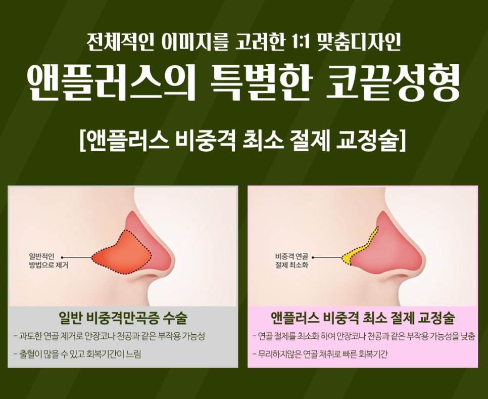 강남코성형 예쁜 코끝성형으로 이미지 개선 관련 이미지 9