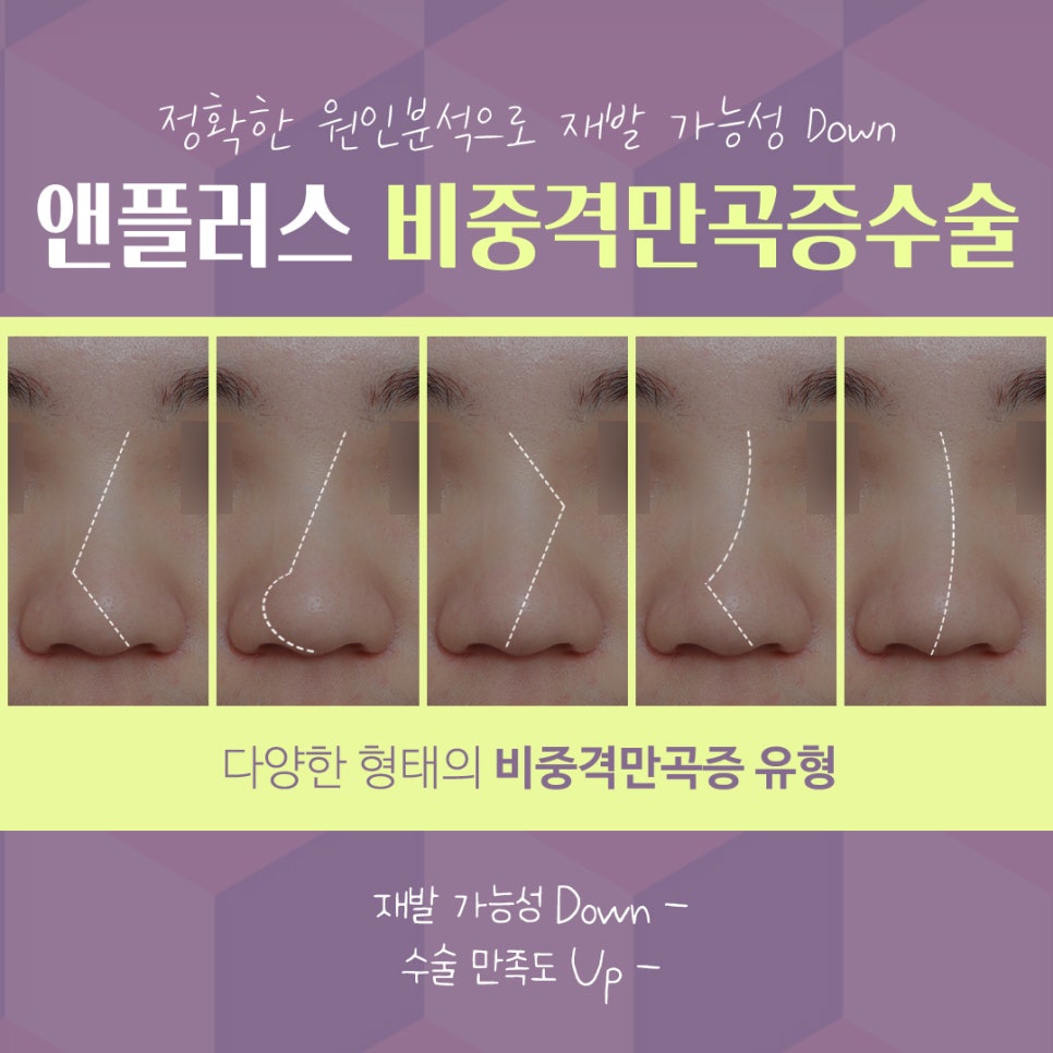 비중격만곡증수술후기 라인까지 고려해서 관련 이미지 6