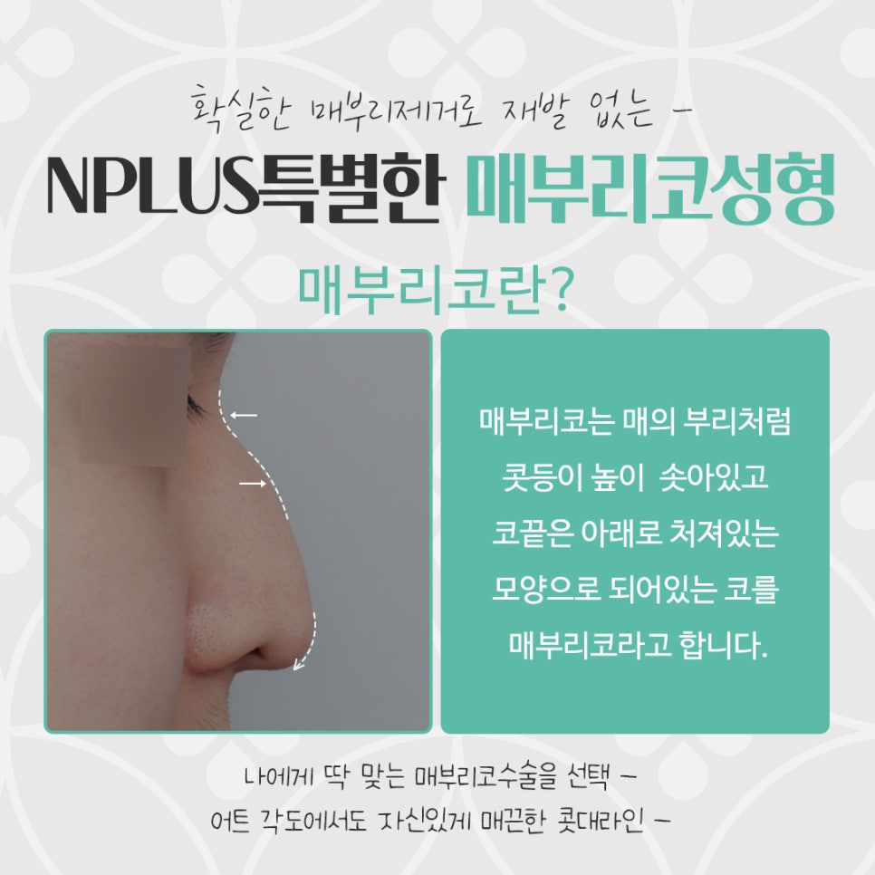 매부리코성형후기 부드러운 인상으로 관련 이미지 4