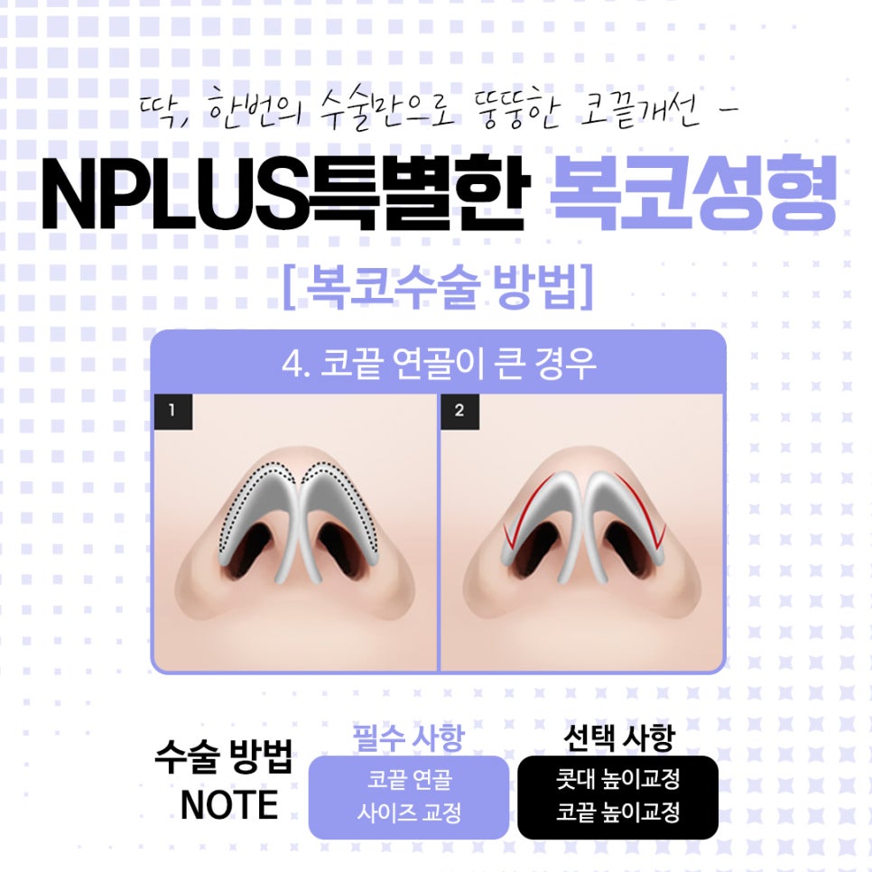 복코수술전후에 대해 자세히 찾아보고 관련 이미지 11