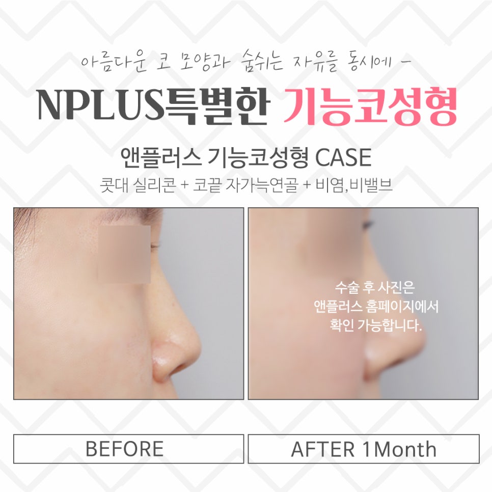 기능코성형후기 원인 파악을 확실하게 관련 이미지 15