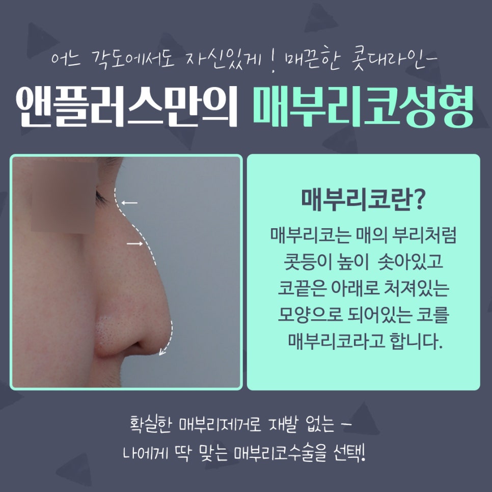 매부리코성형후기 매끈하고 예쁜코라인으로 관련 이미지 4