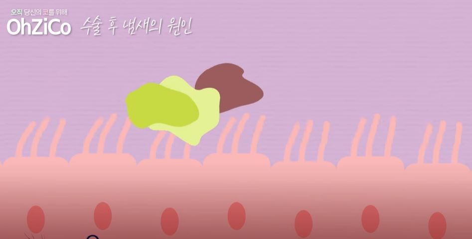 코수술 후 코냄새 원인과 해결 방법! 관련 이미지 8