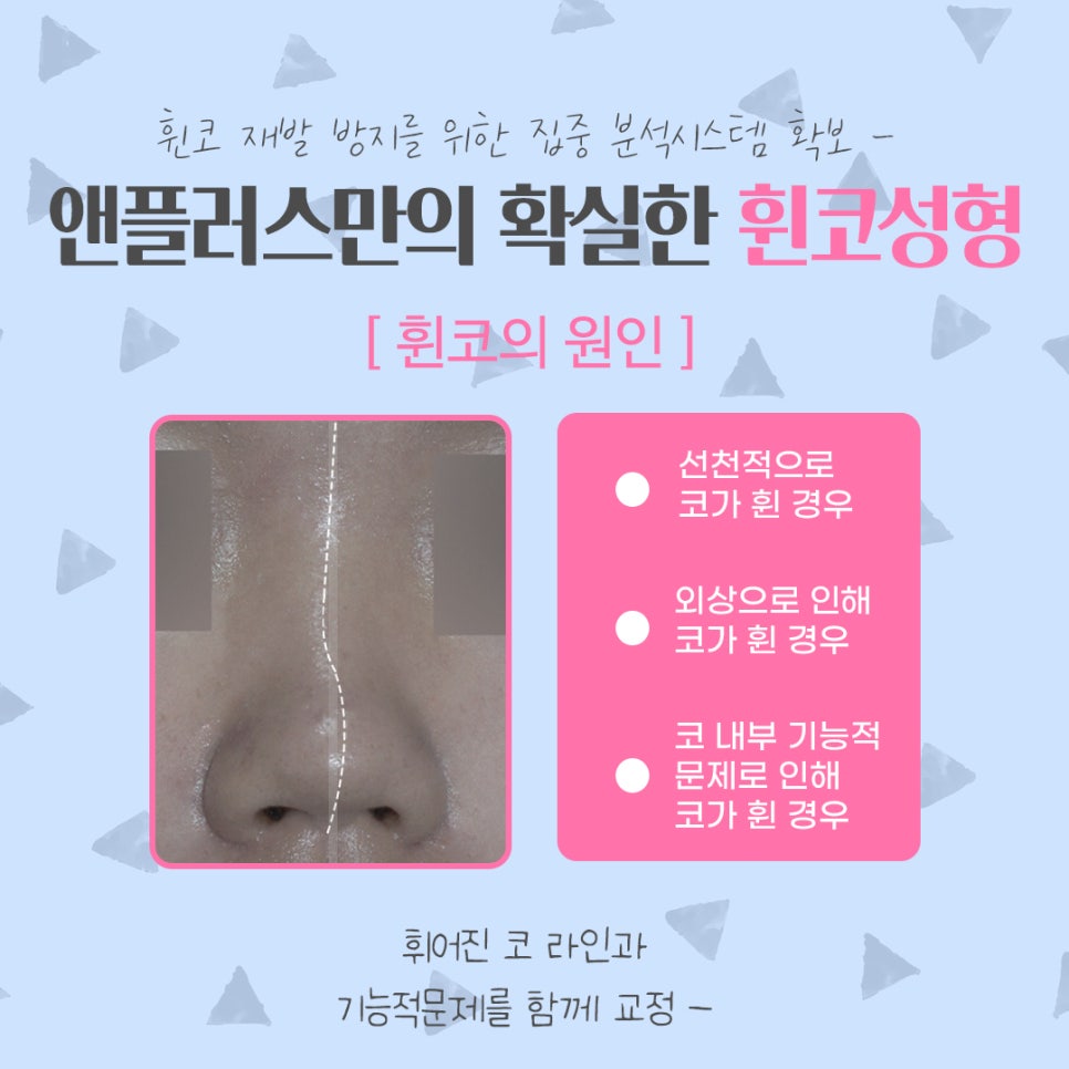 휜코성형 정확한 문제 파악으로 관련 이미지 6