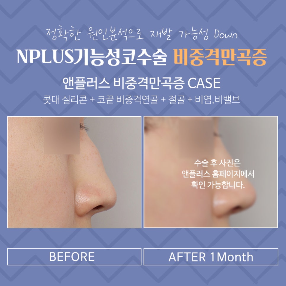 비중격만곡증수술 후기까지 꼼꼼하게 알아보고 관련 이미지 11
