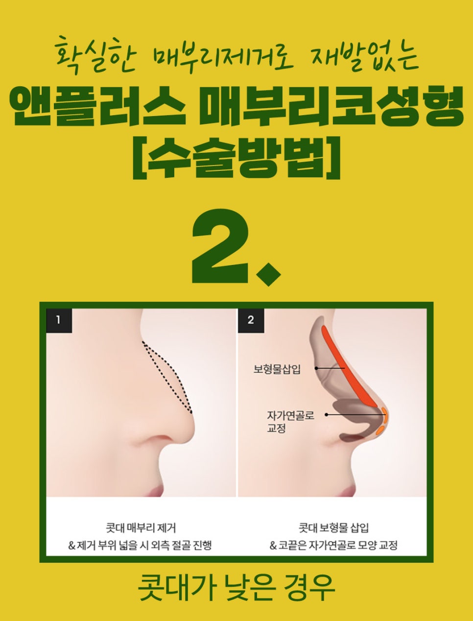 매부리코교정후기_깔끔하게 제거해야 관련 이미지 6
