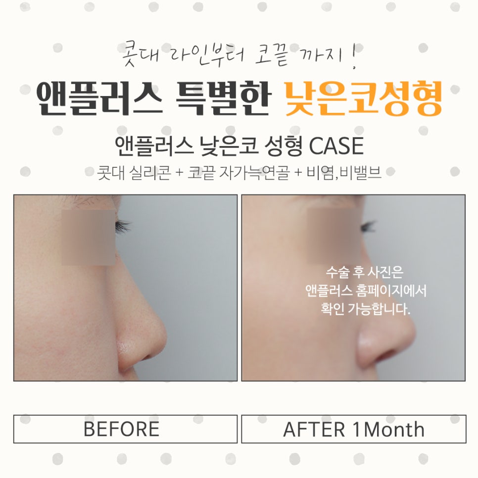 Check the Changes in Low Nose Surgery image 13