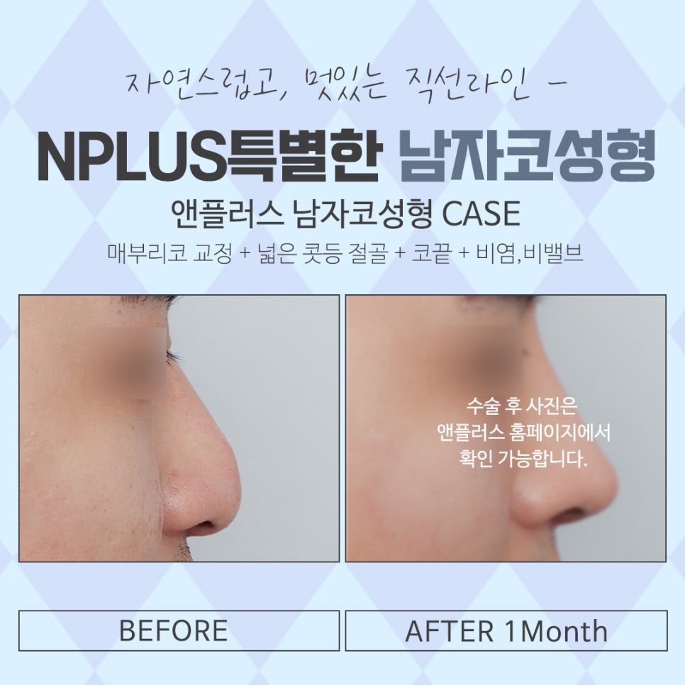 남자코성형전후 강남앤플러스에서 확인 관련 이미지 16