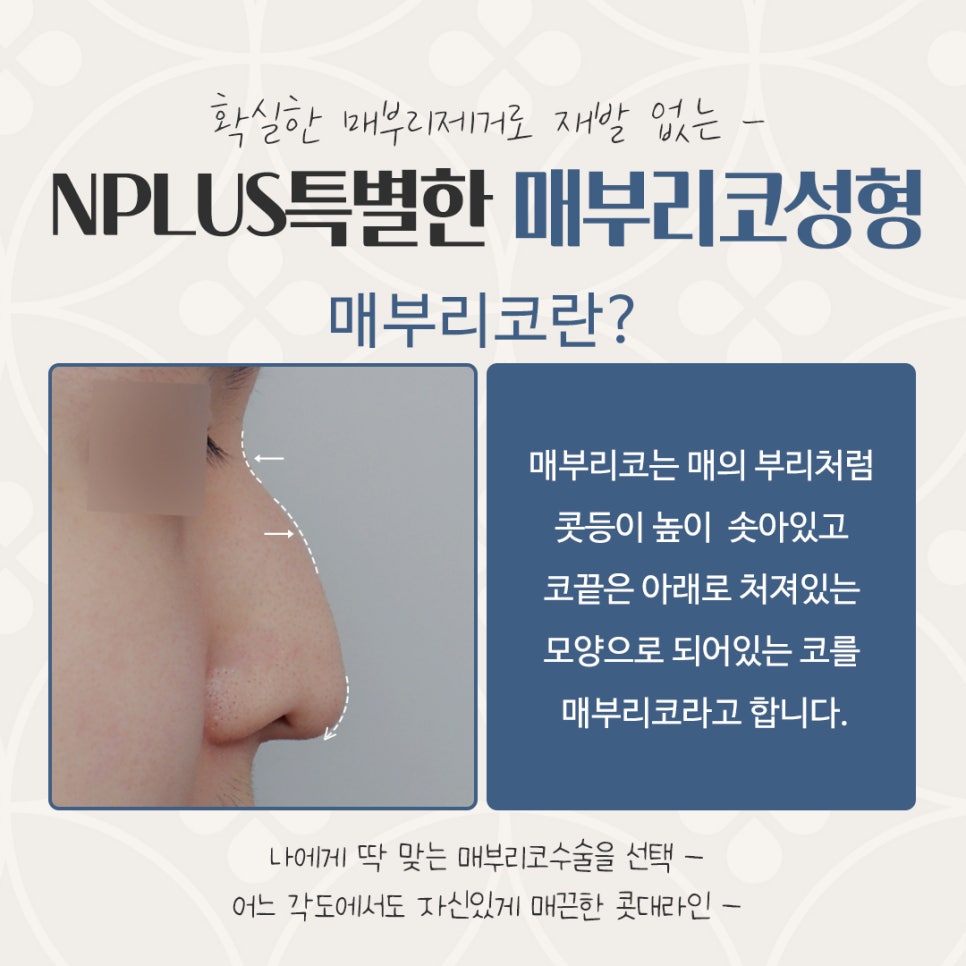 매부리코수술 후기까지 상세하게 알아보고 관련 이미지 3