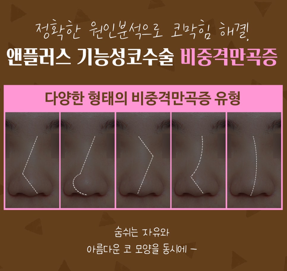 비중격만곡증수술후기 코막힘 고민 해결 관련 이미지 5