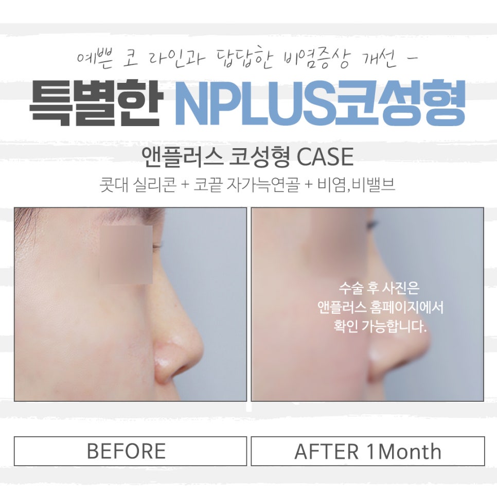 Looking Into Low Nose Rhinoplasty to Improve Your Image image 12