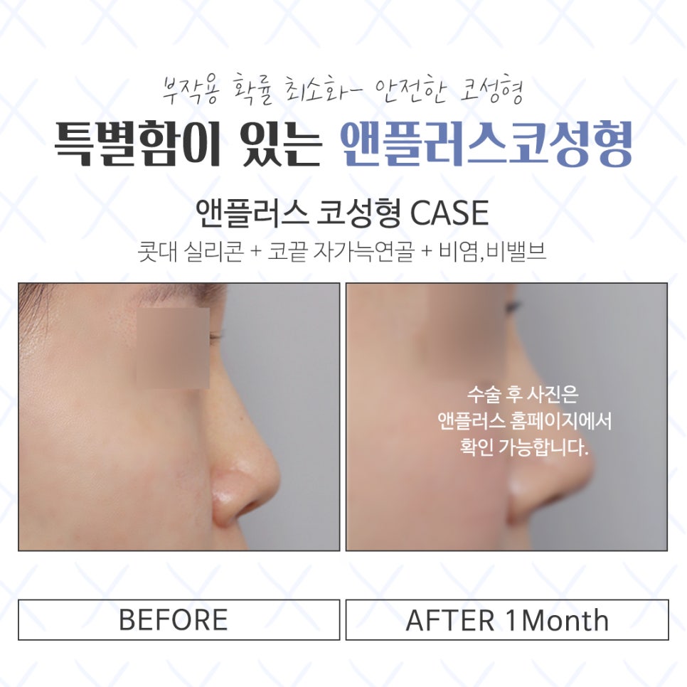 Looking Closely at the Differences Before and After Nose Surgery image 16