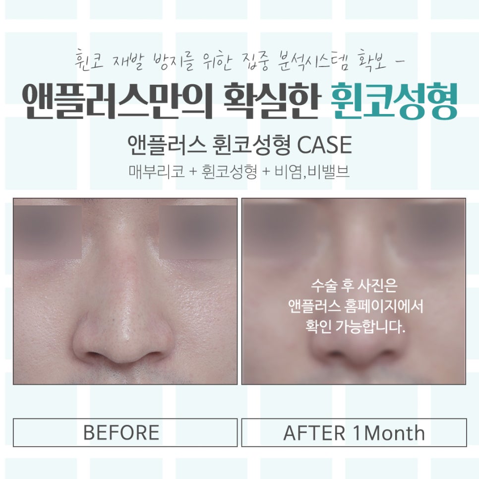 Understanding the Issues in Crooked Nose Surgery Accurately image 13