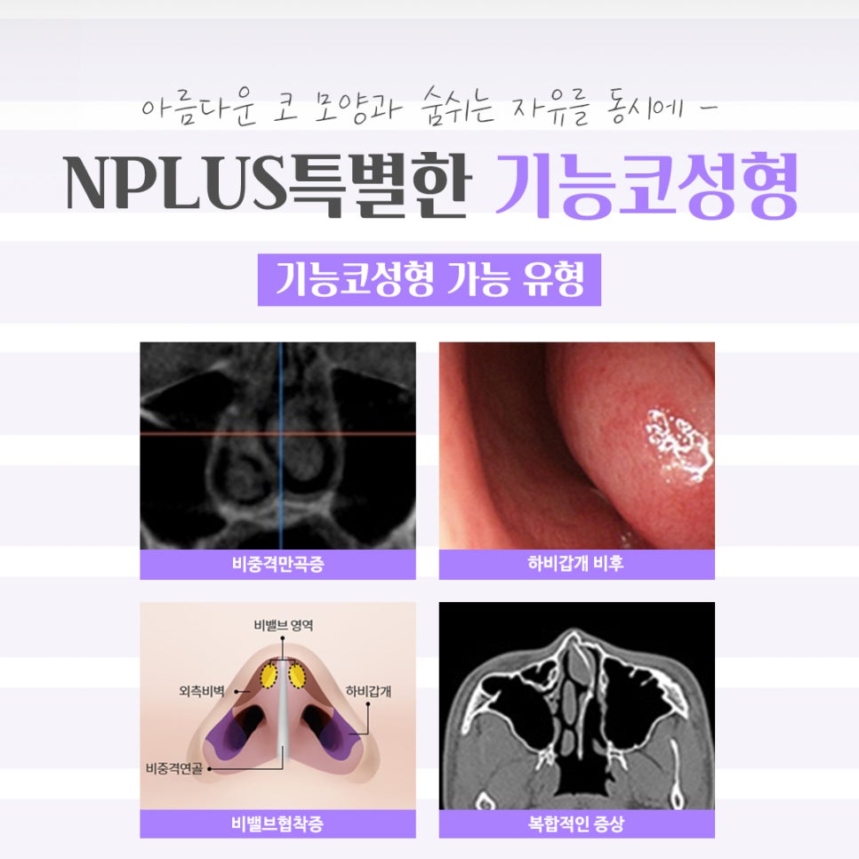 기능코성형후기 꼼꼼하게 체크하고 관련 이미지 5