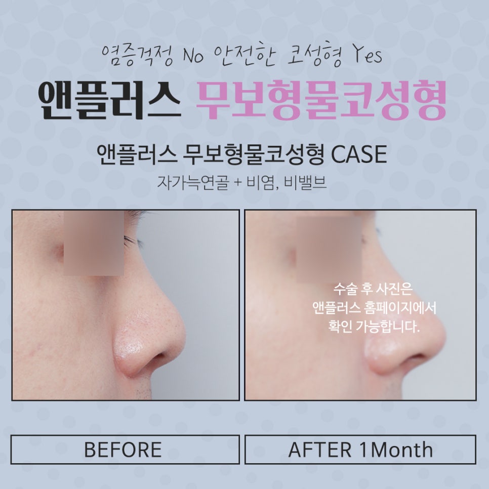 Deciding After Carefully Reviewing Non-Implant Rhinoplasty Reviews image 7