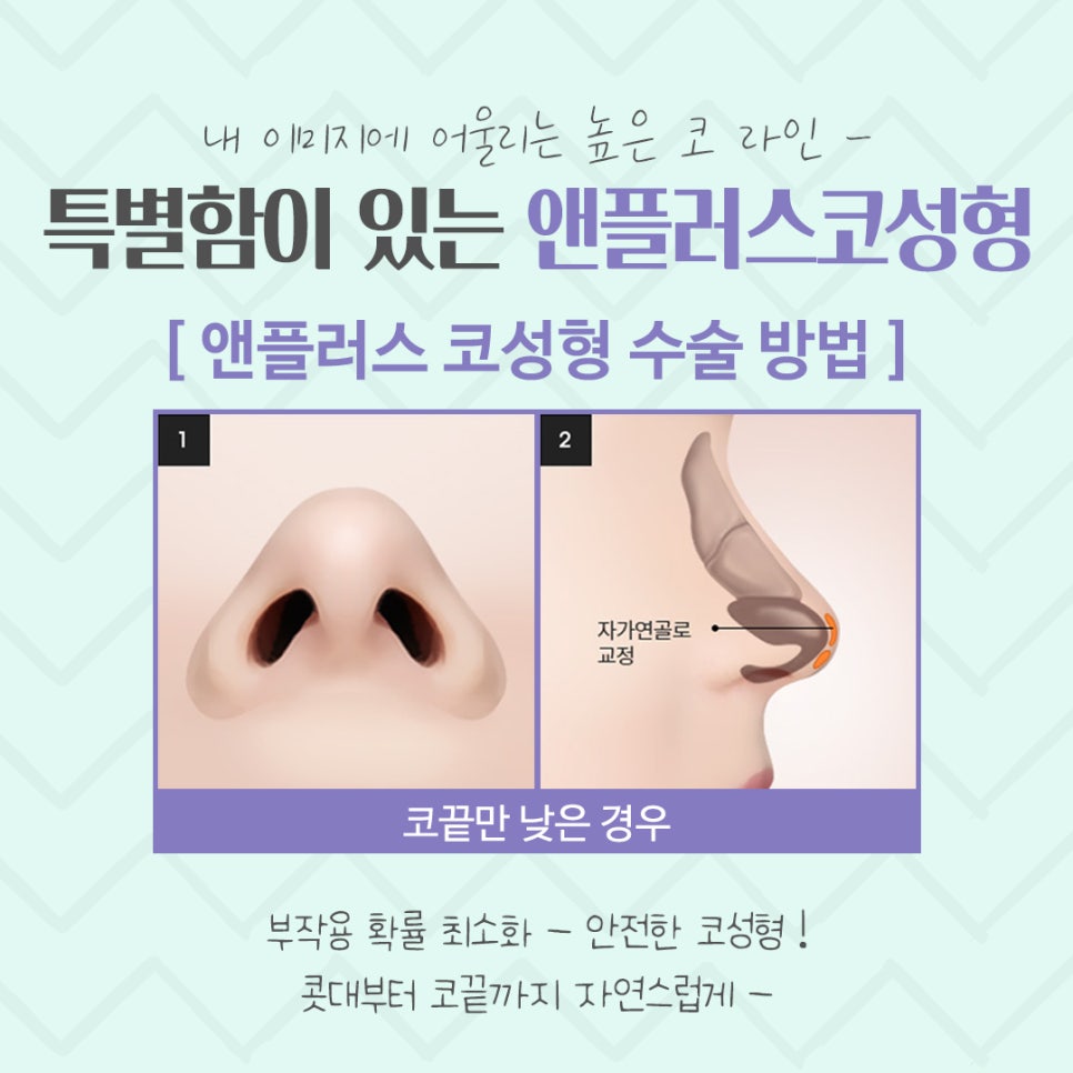 Rhinoplasty Review Considering Functional Aspects image 10