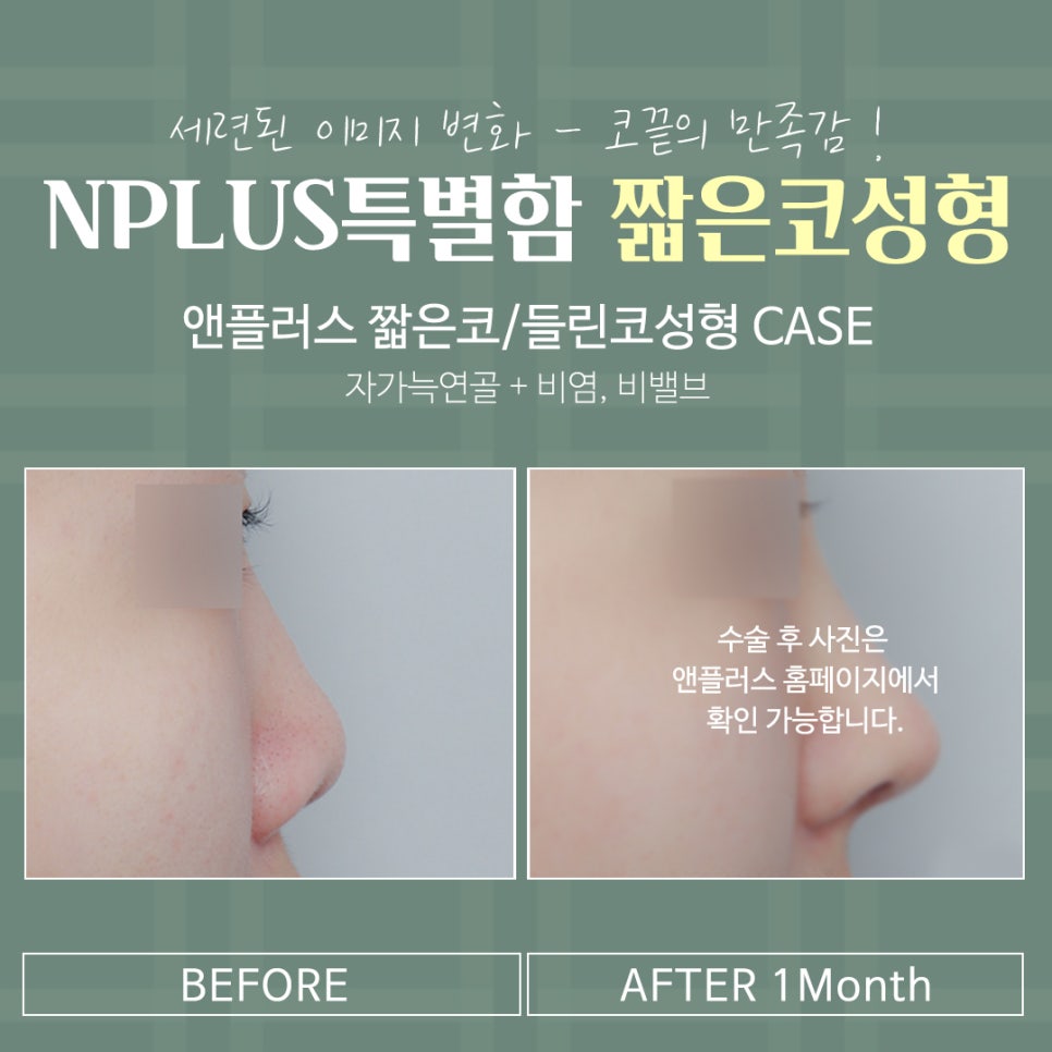Considering the Line in Reviews of Low, Short Nose Surgery image 15