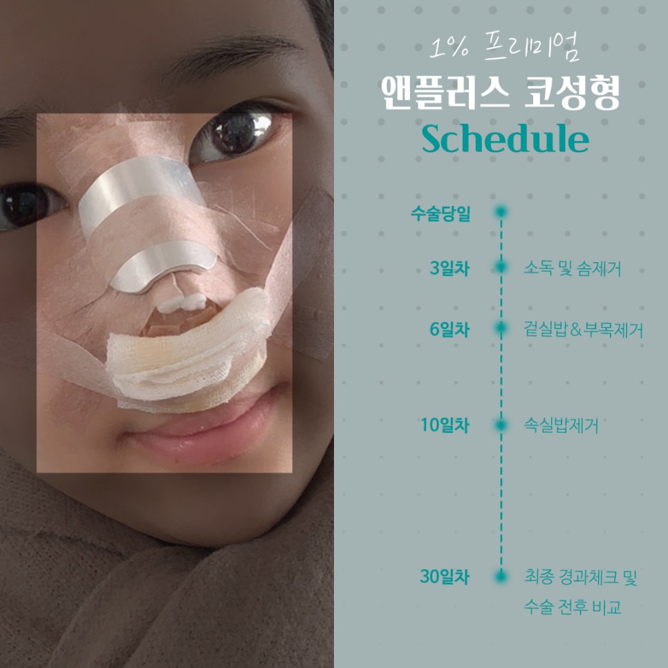 Rhinoplasty Precautions Shared by N+ image 11