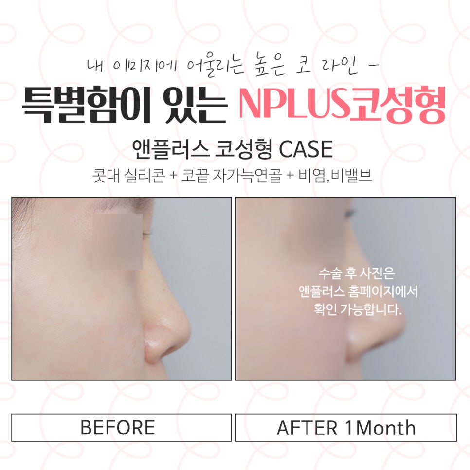 코수술후기 정확한 진단으로 관련 이미지 14