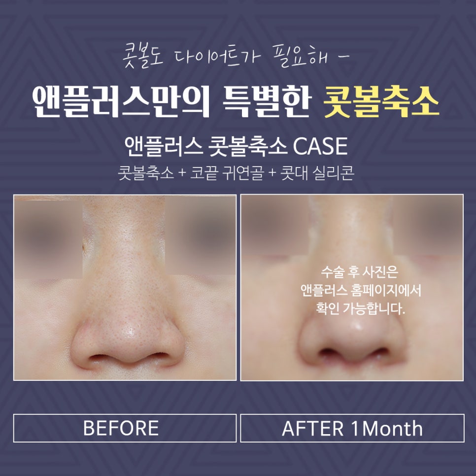 Non-Scar Alar Reduction to Improve a Bulbous Nose image 11