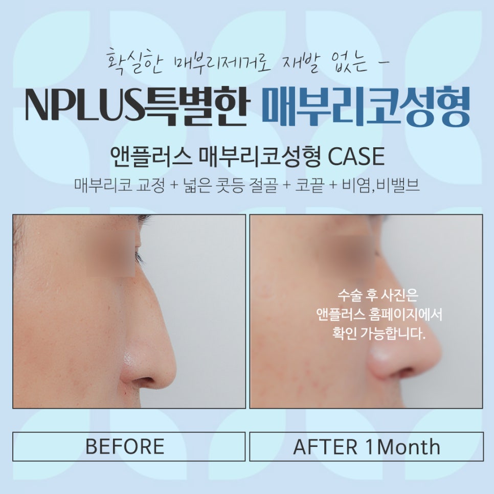 남자매부리코 원인을 정확하게 파악하고 관련 이미지 17