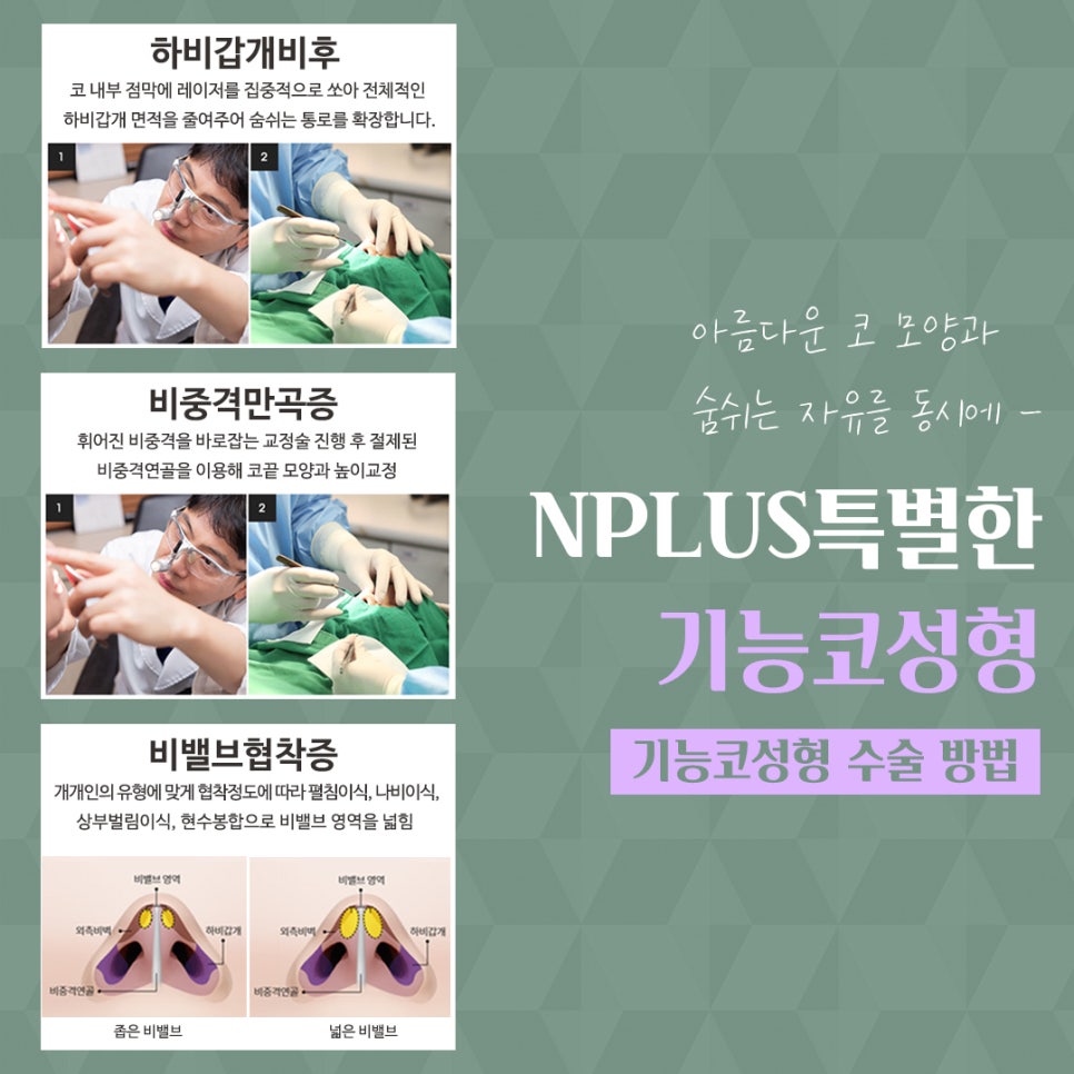 코수술후기 라인까지 고려해서 관련 이미지 8