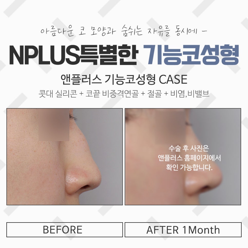 비염코성형실비 꼼꼼하게 체크하고 관련 이미지 14