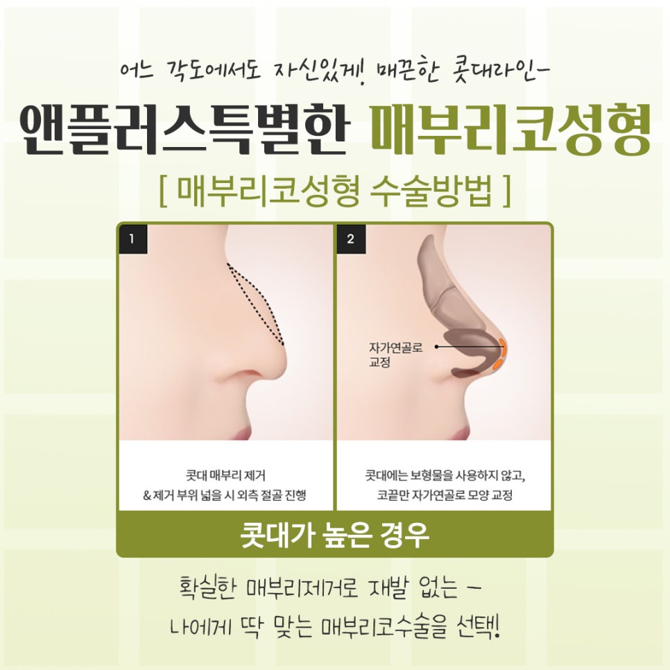 If You’re Looking for Reviews of Hump Nose Surgery image 9