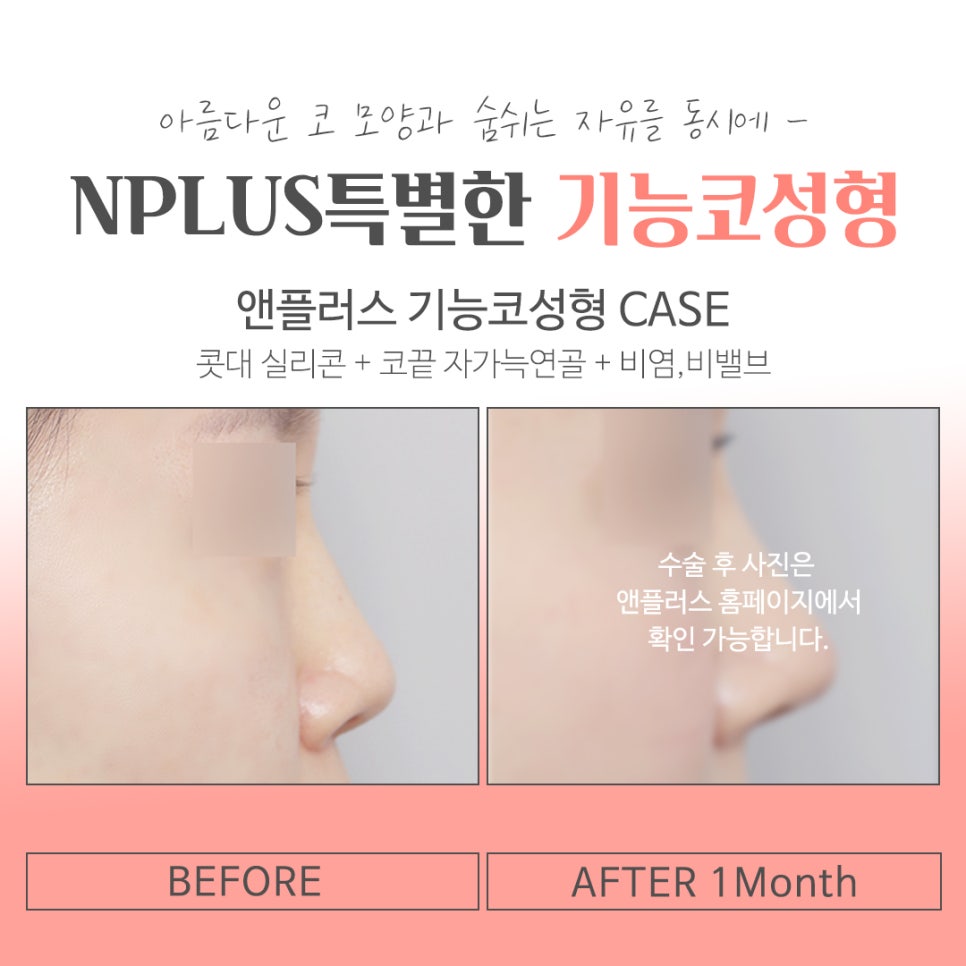 기능코성형후기 여러 가지를 비교하고 관련 이미지 15