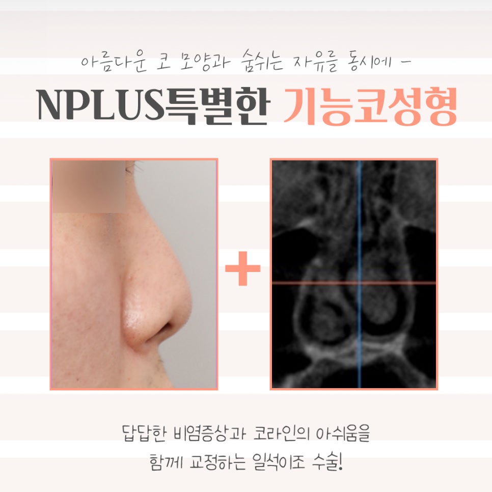 기능코성형후기에 대해 상세히 알아보고 관련 이미지 3