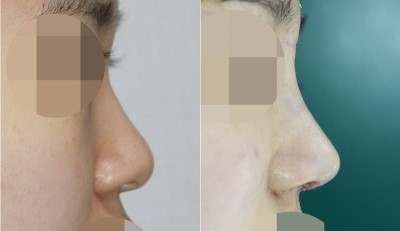 앤플러스성형외과 _ 낮은코 수술 전후사진 관련 이미지 1
