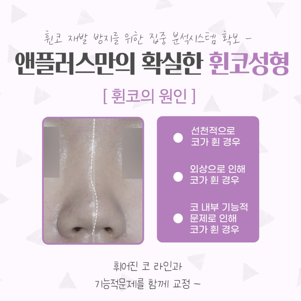휜코성형후기 기능까지 확인해야 관련 이미지 2