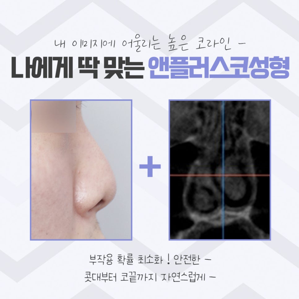 코성형후기 이미지를 예쁘고 자연스럽게 관련 이미지 4