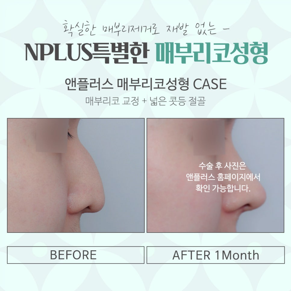 코성형 후에도 매부리재발이 될 수 있나요? 관련 이미지 14