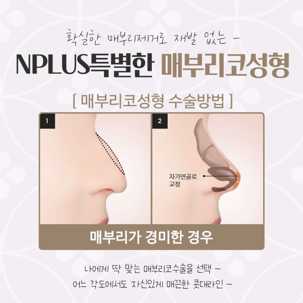 Checking a Hump Nose Surgery Review in Various Ways image 10