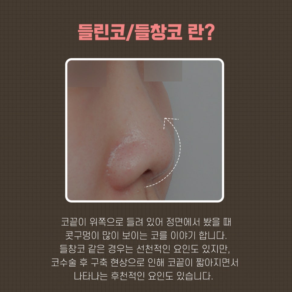 들창코수술후기 튼튼한 비주지지대 관련 이미지 3