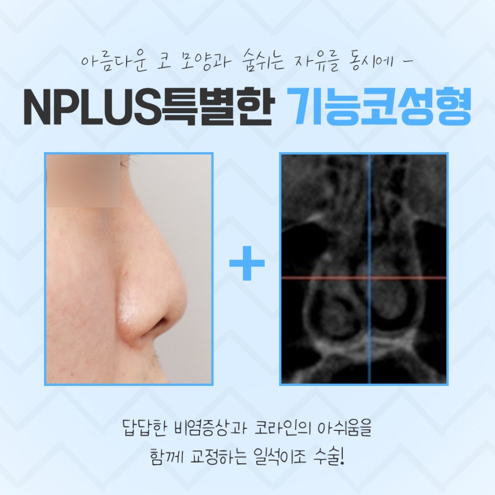 기능코성형후기를 신중하게 알아보고 관련 이미지 4